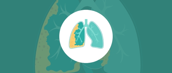 illustrated icon of the lungs and pleura