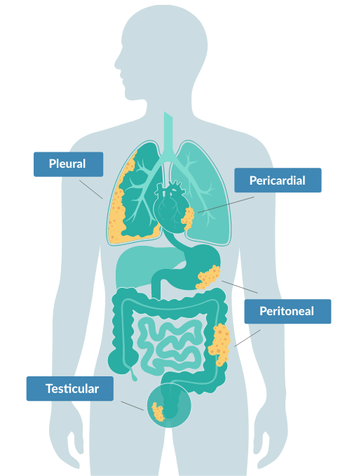 diagram of the body highlighting the areas susceptible to mesothelioma